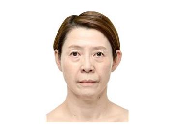 薬用リンクルクイック